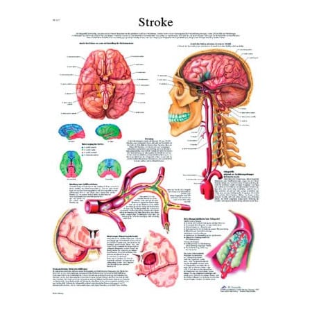 Fabrication Enterprises 3B Anatomical Chart - Stroke Chart Paper 12-4629P